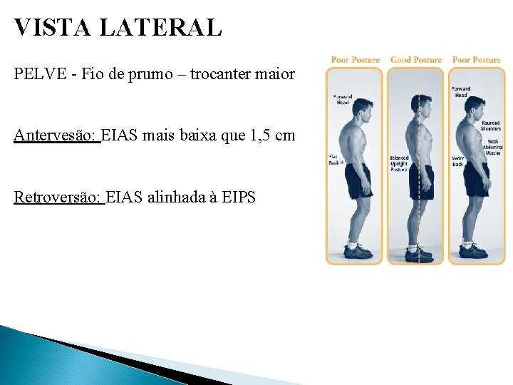 VISTA LATERAL PELVE - Fio de prumo – trocanter maior Antervesão: EIAS mais baixa