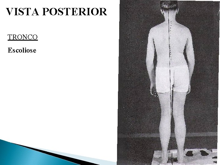 VISTA POSTERIOR TRONCO Escoliose 