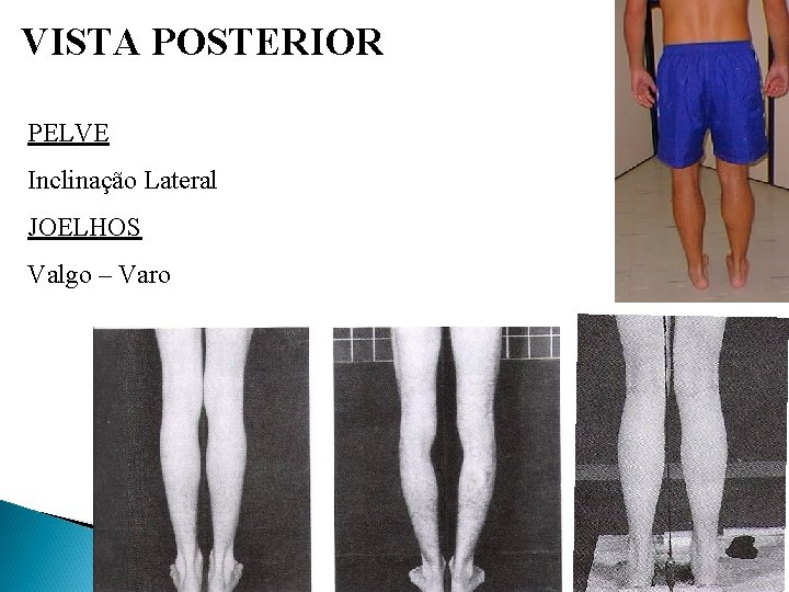 VISTA POSTERIOR PELVE Inclinação Lateral JOELHOS Valgo – Varo 