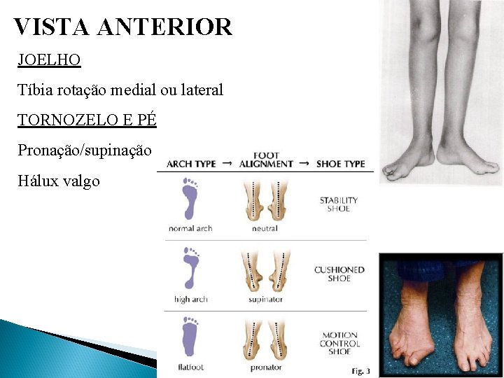 VISTA ANTERIOR JOELHO Tíbia rotação medial ou lateral TORNOZELO E PÉ Pronação/supinação Hálux valgo