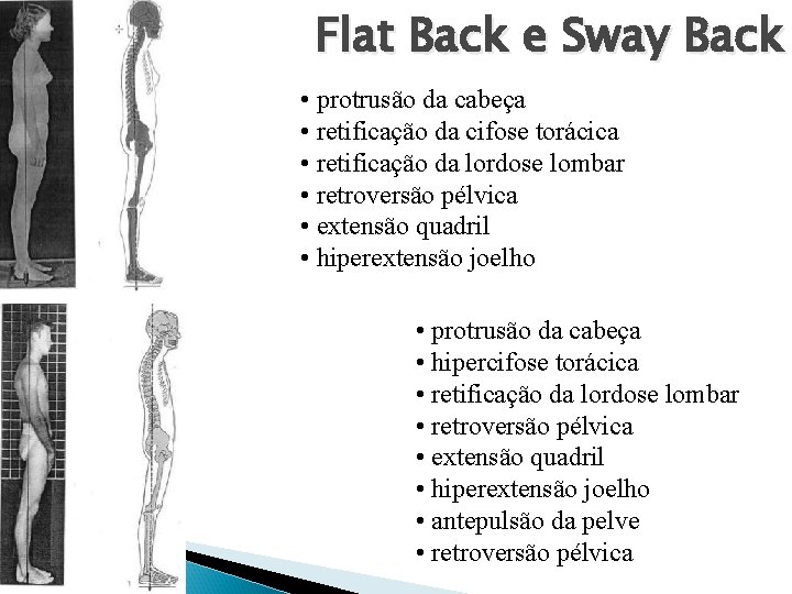 Flat Back e Sway Back • protrusão da cabeça • retificação da cifose torácica