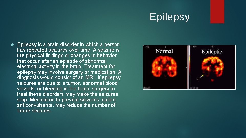 Epilepsy is a brain disorder in which a person has repeated seizures over time.
