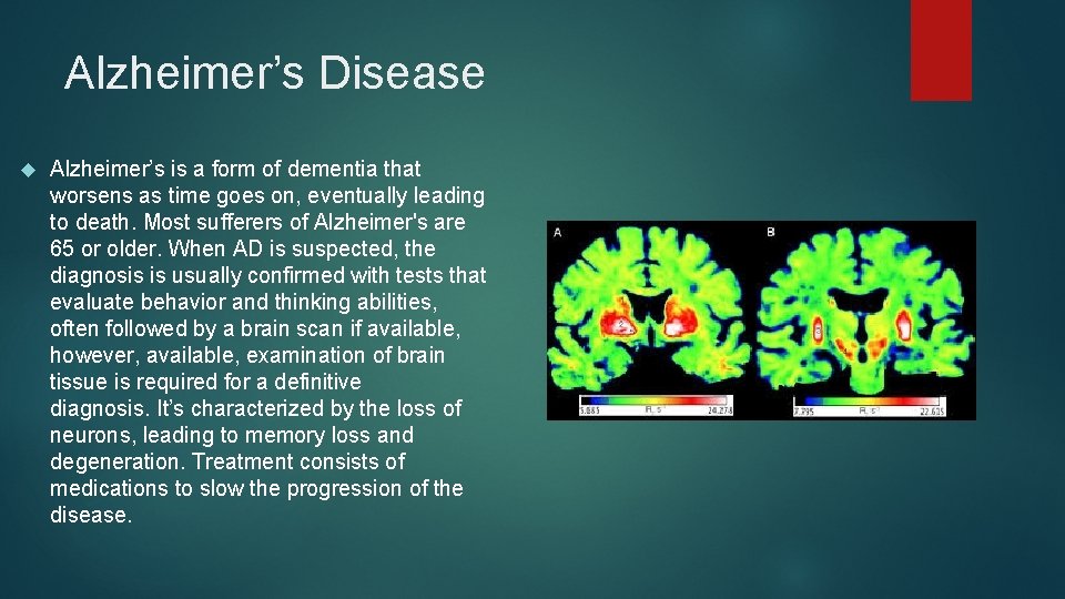 Alzheimer’s Disease Alzheimer’s is a form of dementia that worsens as time goes on,