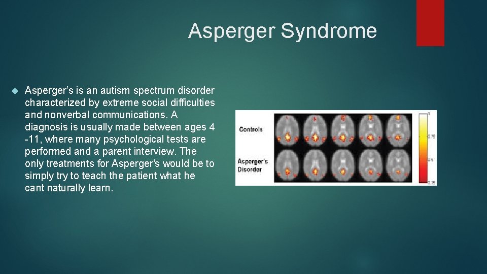 Asperger Syndrome Asperger’s is an autism spectrum disorder characterized by extreme social difficulties and