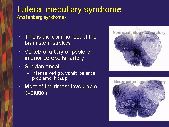 Lateral medullary syndrome (Wallenberg syndrome) • This is the commonest of the brain stem