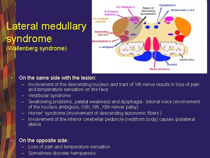 Lateral medullary syndrome (Wallenberg syndrome) • On the same side with the lesion: –