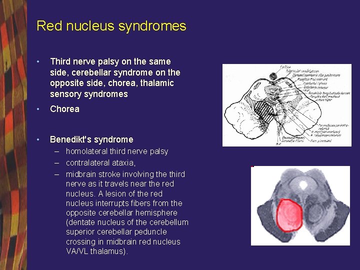 Red nucleus syndromes • Third nerve palsy on the same side, cerebellar syndrome on