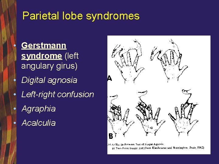 Parietal lobe syndromes • Gerstmann syndrome (left angulary girus) • Digital agnosia • Left-right