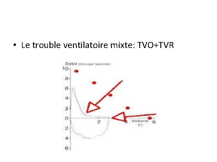  • Le trouble ventilatoire mixte: TVO+TVR 