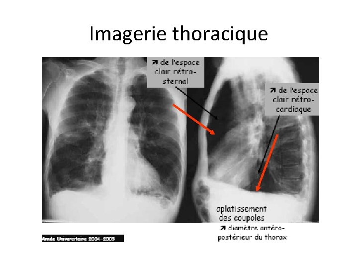 Imagerie thoracique 