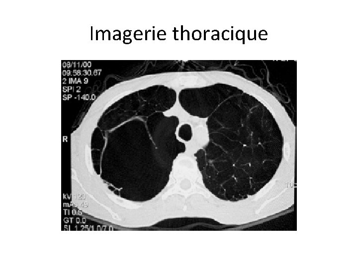 Imagerie thoracique 