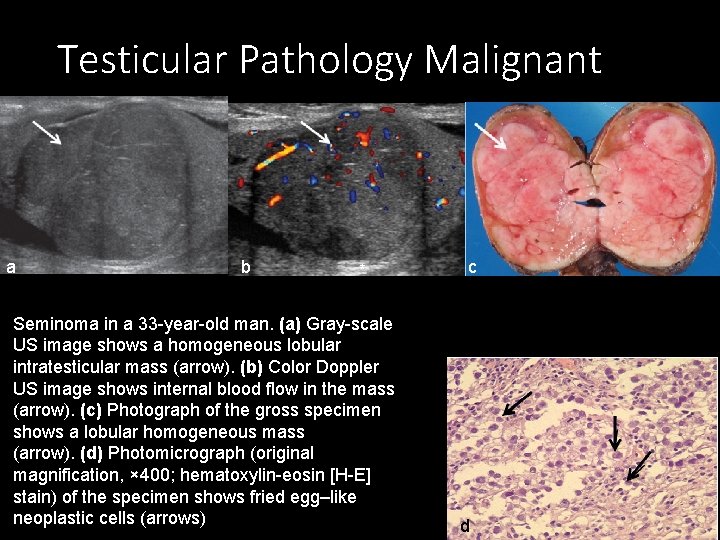 Testicular Pathology Malignant a b * Seminoma in a 33 -year-old man. (a) Gray-scale