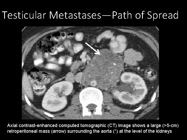 Testicular Metastases—Path of Spread * Axial contrast-enhanced computed tomographic (CT) image shows a large