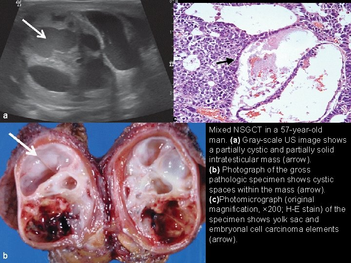 a c Mixed NSGCT in a 57 -year-old man. (a) Gray-scale US image shows