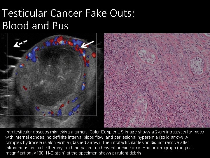 Testicular Cancer Fake Outs: Blood and Pus Intratesticular abscess mimicking a tumor. Color Doppler