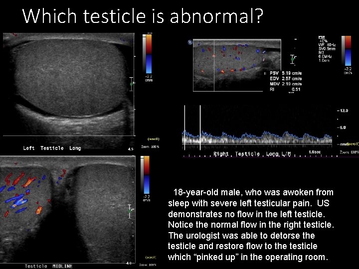 Which testicle is abnormal? 18 -year-old male, who was awoken from sleep with severe