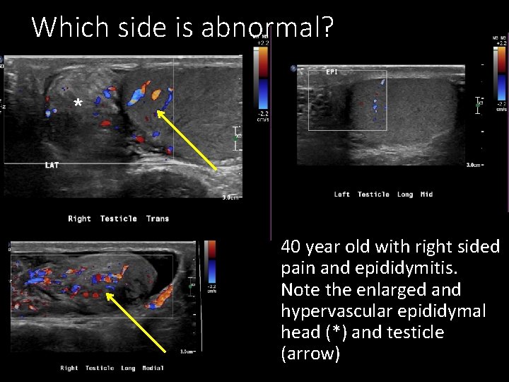 Which side is abnormal? * 40 year old with right sided pain and epididymitis.