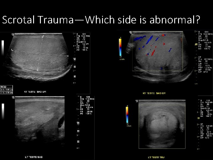 Scrotal Trauma—Which side is abnormal? 