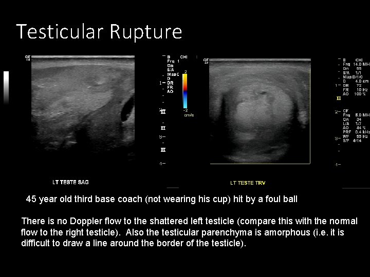 Testicular Rupture 45 year old third base coach (not wearing his cup) hit by