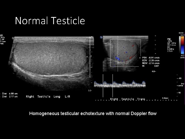 Normal Testicle Homogeneous testicular echotexture with normal Doppler flow 