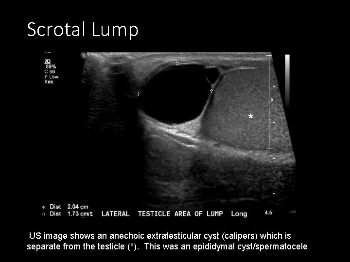 Scrotal Lump * US image shows an anechoic extratesticular cyst (calipers) which is separate