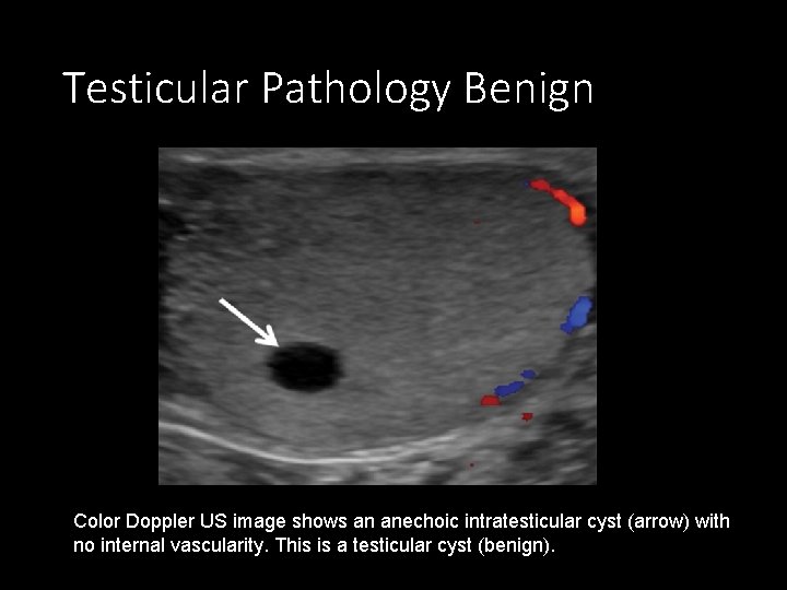 Testicular Pathology Benign Color Doppler US image shows an anechoic intratesticular cyst (arrow) with