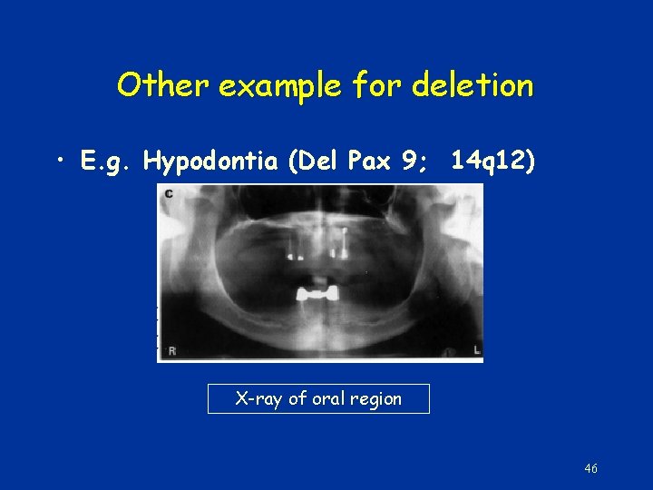 Other example for deletion • E. g. Hypodontia (Del Pax 9; 14 q 12)