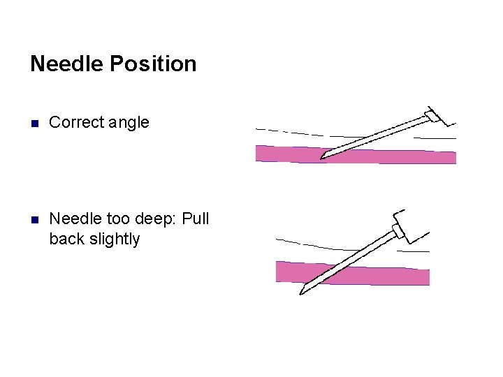 Needle Position n Correct angle n Needle too deep: Pull back slightly 