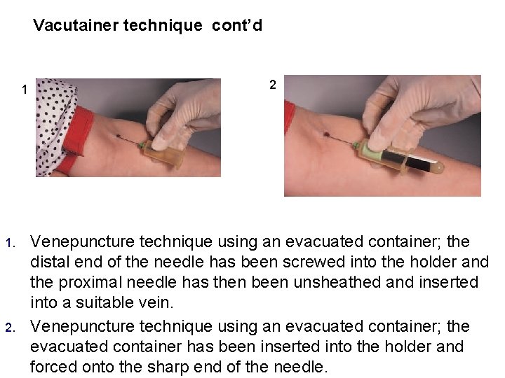 Vacutainer technique cont’d 1 1. 2 Venepuncture technique using an evacuated container; the distal