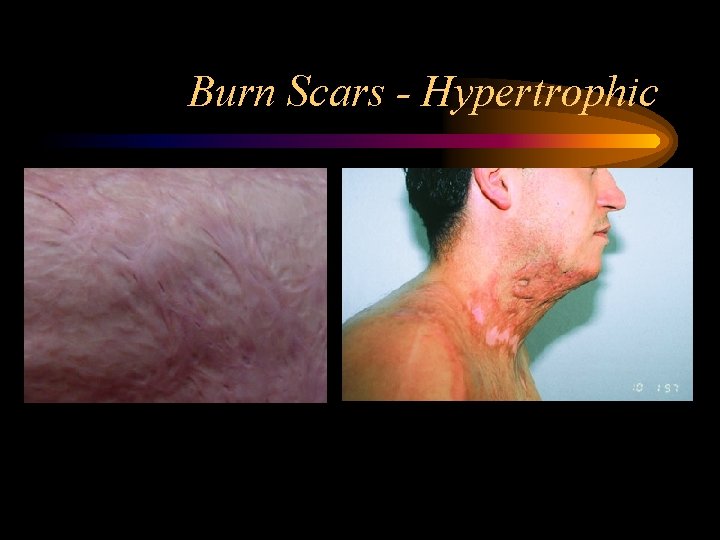 Burn Scars - Hypertrophic 