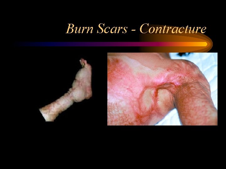 Burn Scars - Contracture 