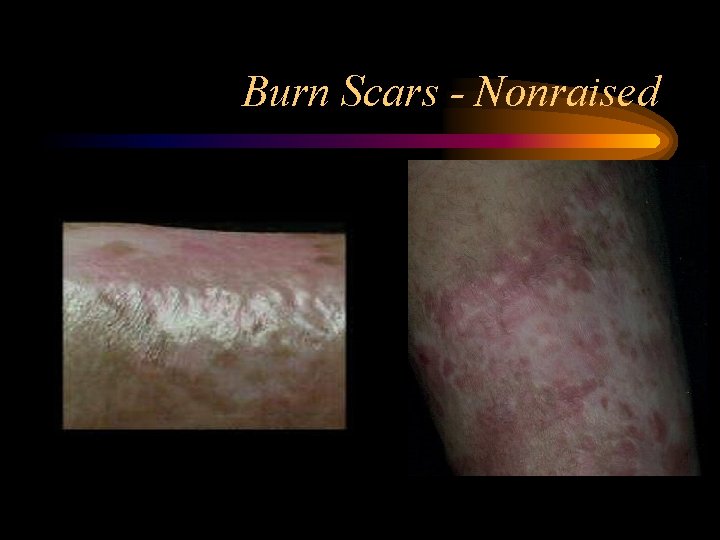 Burn Scars - Nonraised 