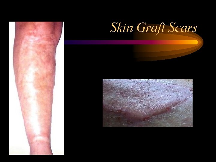 Skin Graft Scars 