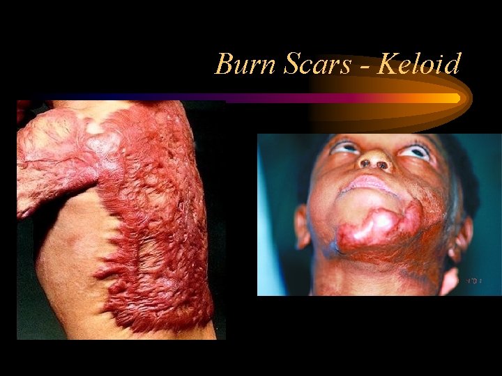 Burn Scars - Keloid 