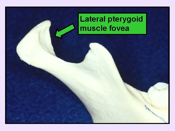 Lateral pterygoid muscle fovea 