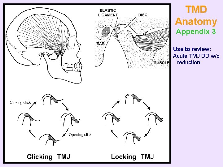 TMD Anatomy Appendix 3 Use to review: Acute TMJ DD w/o reduction 