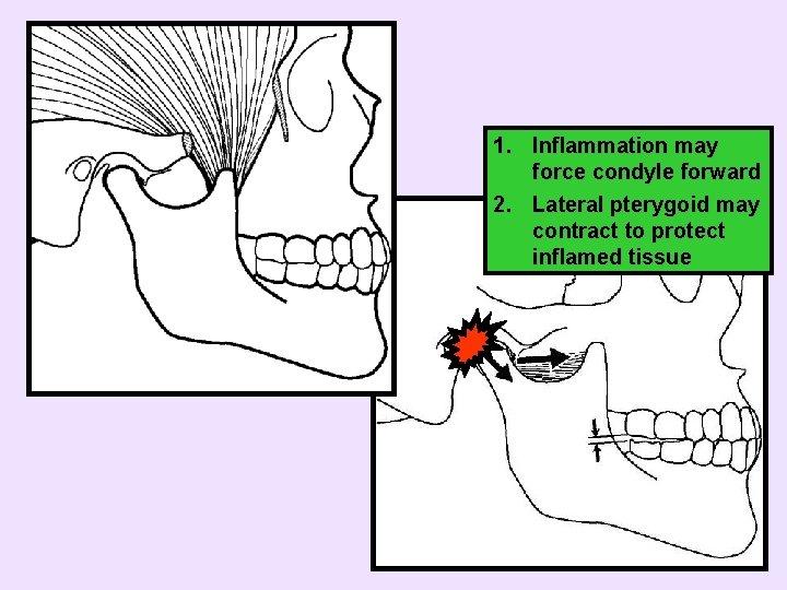 1. Inflammation may force condyle forward 2. Lateral pterygoid may contract to protect inflamed