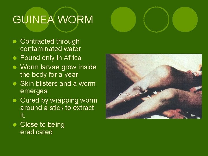 GUINEA WORM l l l Contracted through contaminated water Found only in Africa Worm