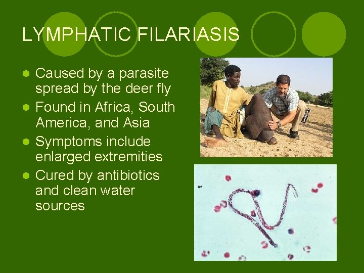 LYMPHATIC FILARIASIS Caused by a parasite spread by the deer fly l Found in