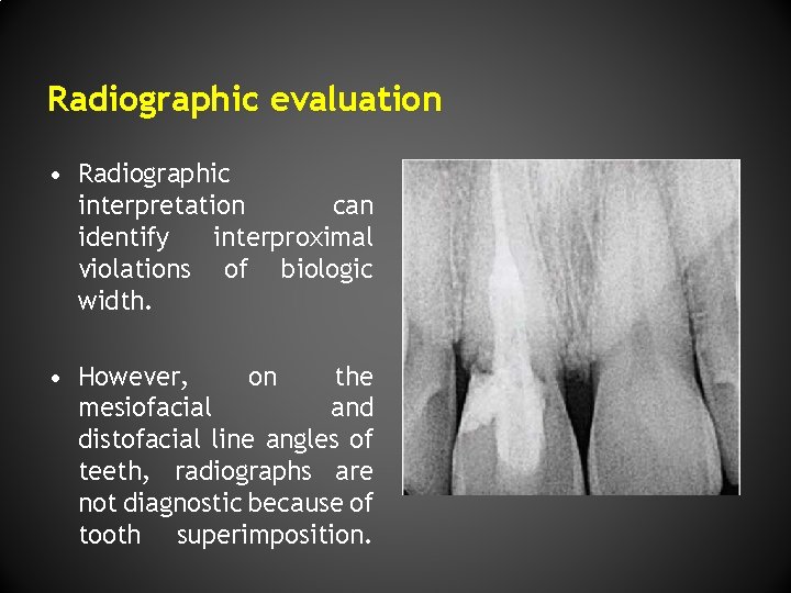 Radiographic evaluation • Radiographic interpretation can identify interproximal violations of biologic width. • However,