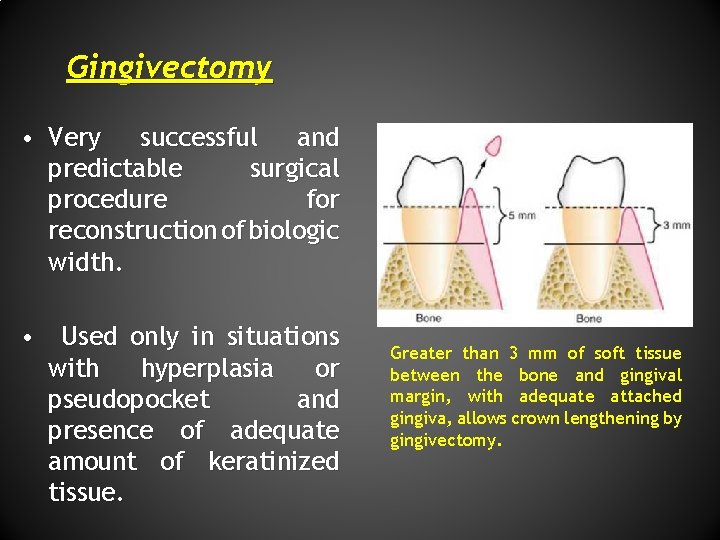 Gingivectomy • Very successful and predictable surgical procedure for reconstruction of biologic width. •