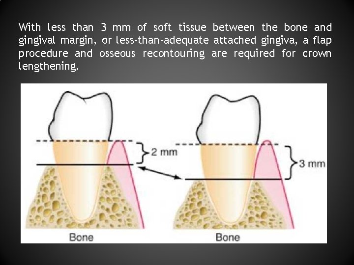 With less than 3 mm of soft tissue between the bone and gingival margin,