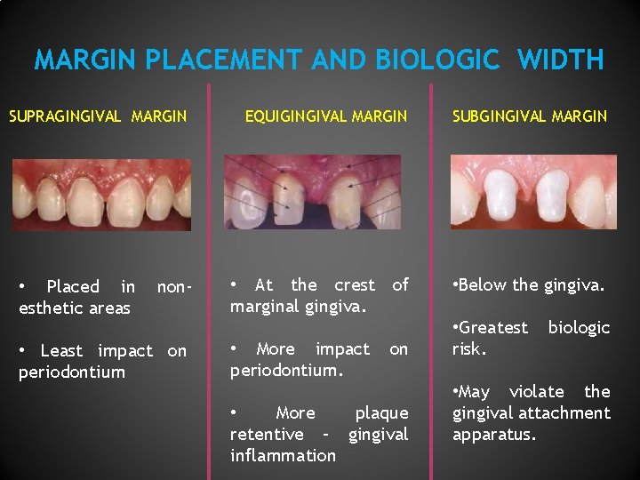 MARGIN PLACEMENT AND BIOLOGIC WIDTH SUPRAGINGIVAL MARGIN • Placed in esthetic areas non- •