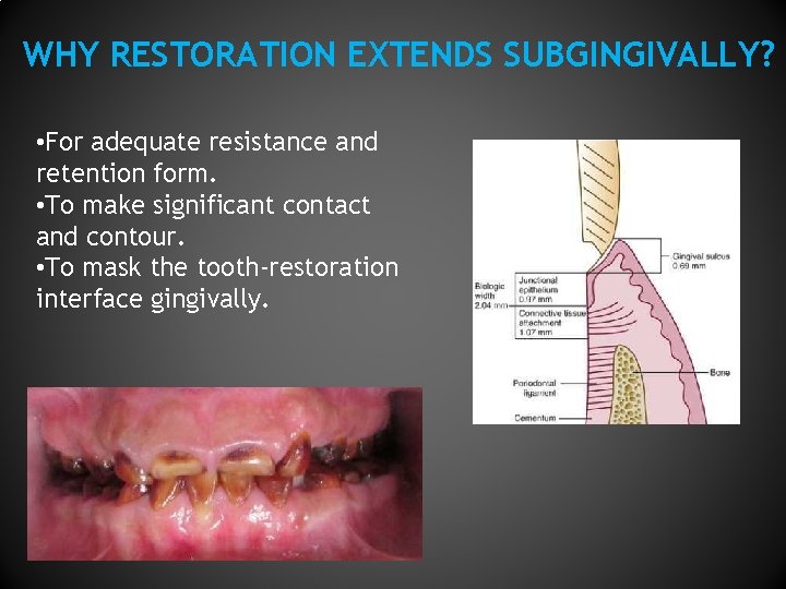 WHY RESTORATION EXTENDS SUBGINGIVALLY? • For adequate resistance and retention form. • To make