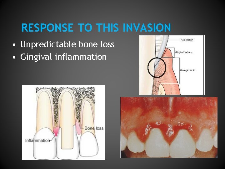 RESPONSE TO THIS INVASION • Unpredictable bone loss • Gingival inflammation 