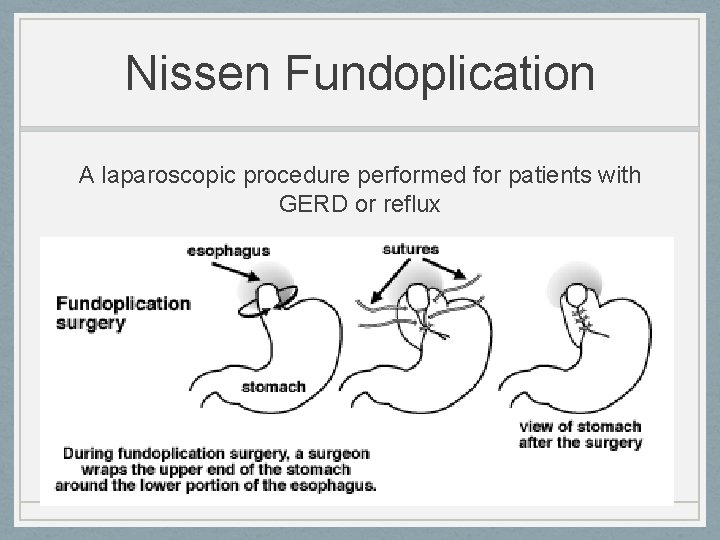 Nissen Fundoplication A laparoscopic procedure performed for patients with GERD or reflux 