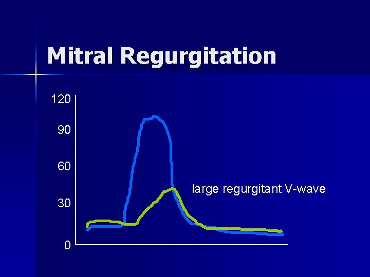 Mitral Regurgitation 120 90 60 large regurgitant V-wave 30 0 