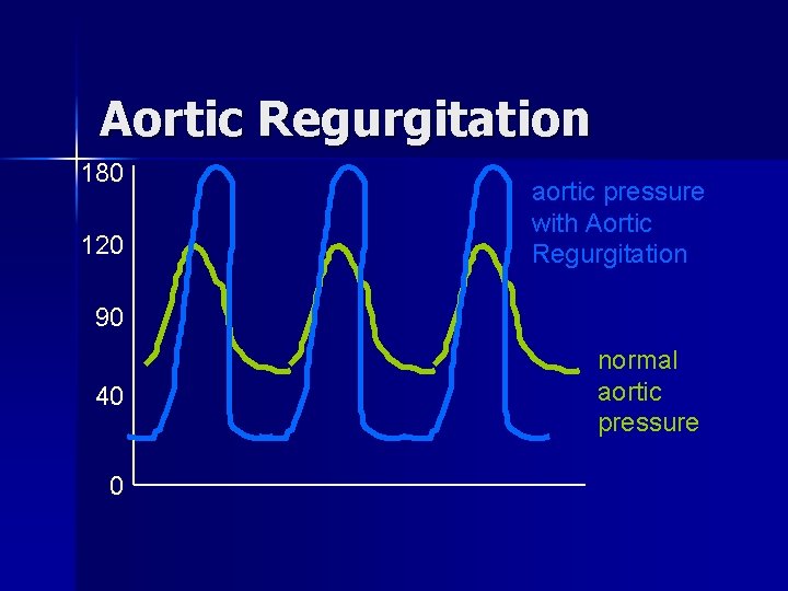Aortic Regurgitation 180 120 aortic pressure with Aortic Regurgitation 90 40 0 normal aortic