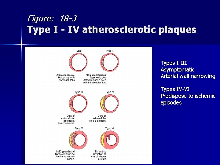 Figure: 18 -3 Type I - IV atherosclerotic plaques Types I-III Asymptomatic Arterial wall