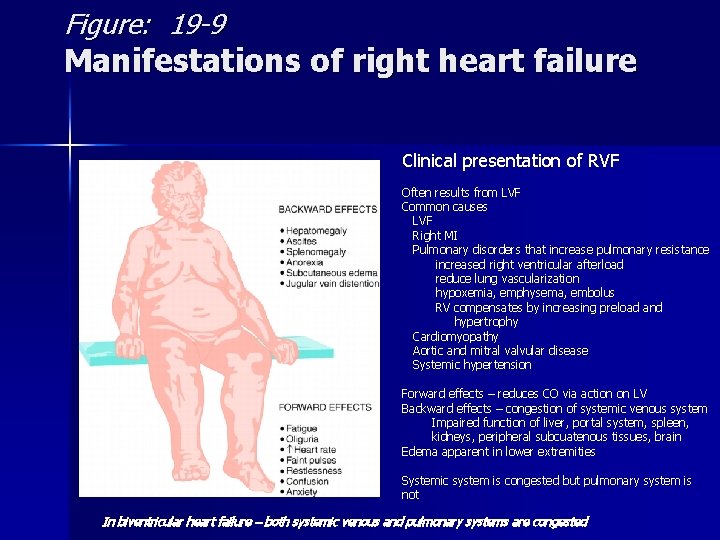 Figure: 19 -9 Manifestations of right heart failure Clinical presentation of RVF Often results